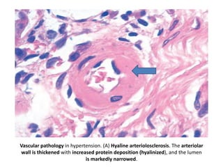 Vascular pathology in hypertension. (A) Hyaline arteriolosclerosis. The arteriolar
wall is thickened with increased protein deposition (hyalinized), and the lumen
is markedly narrowed.
 