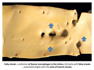 Fatty streak, a collection of foamy macrophages in the intima. (A) Aorta with fatty streaks
, associated largely with the ostia of branch vessels.
 