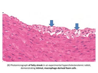 (B) Photomicrograph of fatty streak in an experimental hypercholesterolemic rabbit,
demonstrating intimal, macrophage-derived foam cells .
 