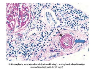 B) Hyperplastic arteriolosclerosis (onion-skinning) causing luminal obliteration
(arrow) (periodic acid-Schiff stain)
 