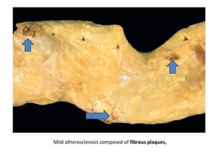 Mild atherosclerosis composed of fibrous plaques,
 