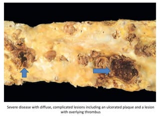 Severe disease with diffuse, complicated lesions including an ulcerated plaque and a lesion
with overlying thrombus
 