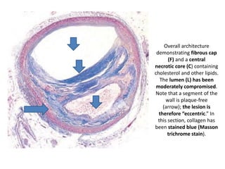 Overall architecture
demonstrating fibrous cap
(F) and a central
necrotic core (C) containing
cholesterol and other lipids.
The lumen (L) has been
moderately compromised.
Note that a segment of the
wall is plaque-free
(arrow); the lesion is
therefore “eccentric.” In
this section, collagen has
been stained blue (Masson
trichrome stain).
 