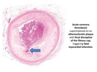 Acute coronary
thrombosis
superimposed on an
atherosclerotic plaque
with focal disruption
of the fibrous cap,
triggering fatal
myocardial infarction.
 