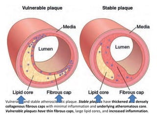 Vulnerable and stable atherosclerotic plaque. Stable plaques have thickened and densely
collagenous fibrous caps with minimal inflammation and underlying atheromatous core.
Vulnerable plaques have thin fibrous caps, large lipid cores, and increased inflammation.
 