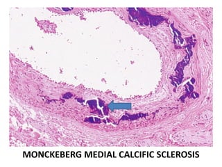 MONCKEBERG MEDIAL CALCIFIC SCLEROSIS
 