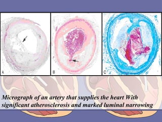 Micrograph of an artery that supplies the heart With
significant atherosclerosis and marked luminal narrowing

 
