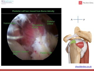 shoulderdoc.co.uk
Athlete
A P
 