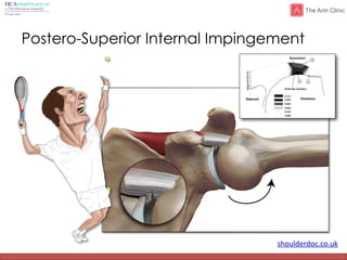 shoulderdoc.co.uk
Postero-Superior Internal Impingement
 