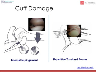 shoulderdoc.co.uk
Cuff Damage
Internal Impingement Repetitive Torsional Forces
 