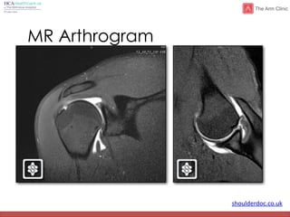 shoulderdoc.co.uk
MR Arthrogram
 