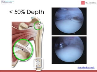 shoulderdoc.co.uk
< 50% Depth
 