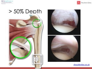 shoulderdoc.co.uk
> 50% Depth
 