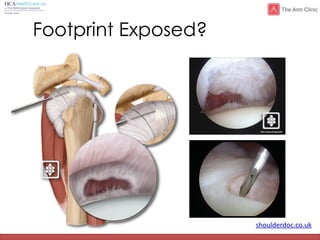 shoulderdoc.co.uk
Footprint Exposed?
 