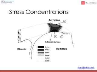shoulderdoc.co.uk
Stress Concentrations
 