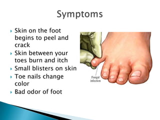    Skin on the foot
    begins to peel and
    crack
   Skin between your
    toes burn and itch
   Small blisters on skin
   Toe nails change
    color
   Bad odor of foot
 