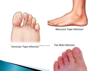 Moccasin Type Infection




                           Toe Web Infection
Vesicular Type Infection
 