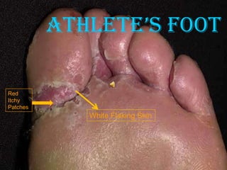 ATHLETE’S FOOT
Red
Itchy
Patches

White Flaking Skin

 