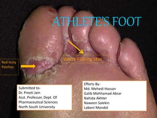 ATHLETE’S FOOT 
Red Itchy 
Patches 
White Flaking Skin 
Efforts By- 
Md. Mehedi Hassan 
Galib Mohhamad Abrar 
Nahida Akhter 
Naween Salekin 
Laboni Mondol 
Submitted to- 
Dr. Preeti Jain 
Asst. Professor, Dept. Of 
Pharmaceutical Sciences 
North South University 
 