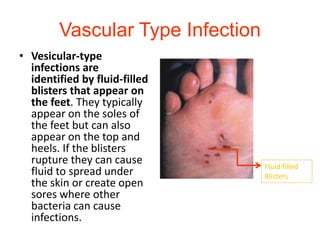 Vascular Type Infection 
• Vesicular-type 
infections are 
identified by fluid-filled 
blisters that appear on 
the feet. They typically 
appear on the soles of 
the feet but can also 
appear on the top and 
heels. If the blisters 
rupture they can cause 
fluid to spread under 
the skin or create open 
sores where other 
bacteria can cause 
infections. 
Fluid filled 
Blisters 
 
