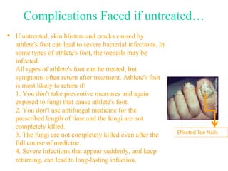 Complications Faced if untreated… 
• If untreated, skin blisters and cracks caused by 
athlete's foot can lead to severe bacterial infections. In 
some types of athlete's foot, the toenails may be 
infected. 
All types of athlete's foot can be treated, but 
symptoms often return after treatment. Athlete's foot 
is most likely to return if: 
1. You don't take preventive measures and again 
exposed to fungi that cause athlete's foot. 
2. You don't use antifungal medicine for the 
prescribed length of time and the fungi are not 
completely killed. 
3. The fungi are not completely killed even after the 
full course of medicine. 
4. Severe infections that appear suddenly, and keep 
returning, can lead to long-lasting infection. 
Effected Toe Nails 
 
