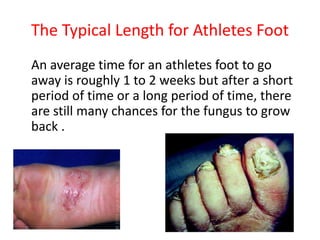 The Typical Length for Athletes Foot 
An average time for an athletes foot to go 
away is roughly 1 to 2 weeks but after a short 
period of time or a long period of time, there 
are still many chances for the fungus to grow 
back . 
 