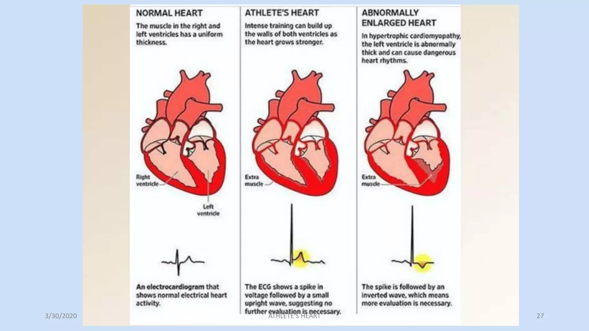 Athlete's heart | PPTX
