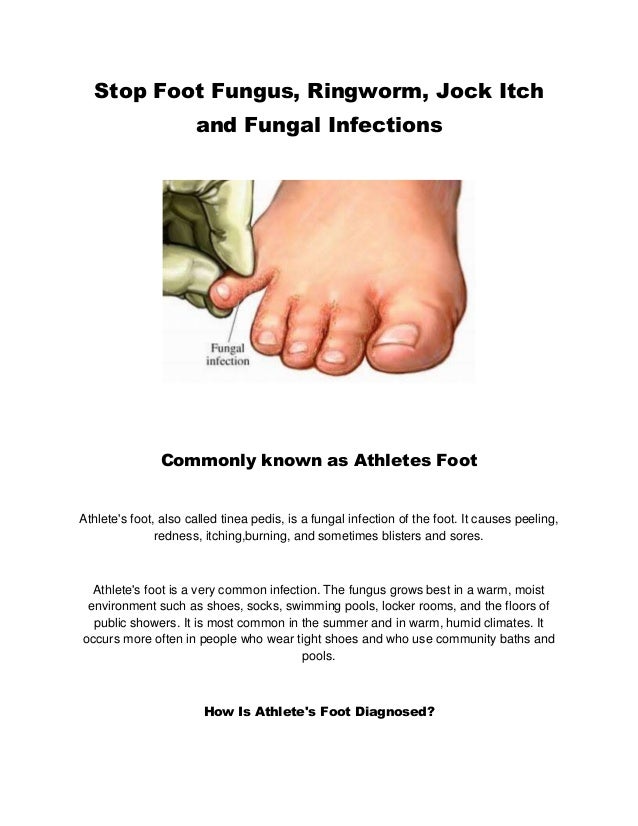 Cure Athletes Foot