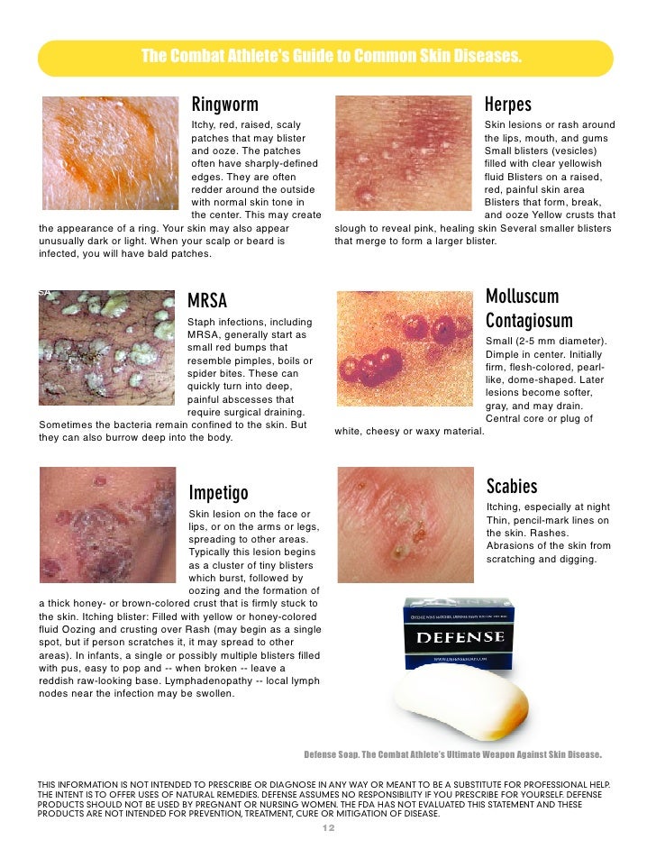 Dermatology Red Ring With Yellowish Center Dermatology Red Ring With Yellowish Center