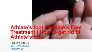 PREPARED BY
MARTIN SHAJI
PHARM D
Athlete’s foot | Athlete’s Foot
Treatment | How to get rid of
Athlete’s foot
 