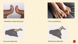 Hitchhiker’s thumb deformity Claw toe deformity
Swan neck deformity Boutonniere deformity 11
 