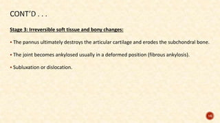Stage 3: Irreversible soft tissue and bony changes:
 The pannus ultimately destroys the articular cartilage and erodes the subchondral bone.
 The joint becomes ankylosed usually in a deformed position (fibrous ankylosis).
 Subluxation or dislocation.
16
 