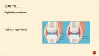 Physical examination:
synovial hypertrophy
20
 