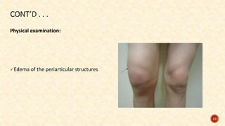 Physical examination:
Edema of the periarticular structures
21
 