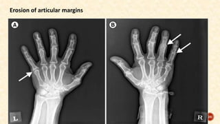 Erosion of articular margins
26
 