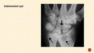 27
Subchondral cyst
 