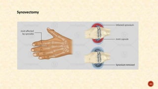 Synovectomy
41
 