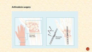 Arthrodesis surgery
42
 