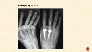 Arthroplasty surgery
43
 