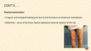 Physical examination:
 Irregular and enlarged-looking joint due to the formation of peripheral osteophytes
 Deformity – varus of the knee, flexion-adduction external rotation of the hip
62
 