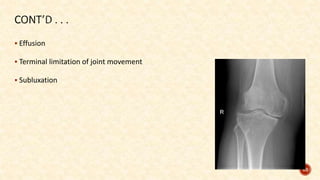  Effusion
 Terminal limitation of joint movement
 Subluxation
63
 