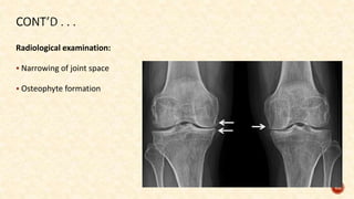 Radiological examination:
 Narrowing of joint space
 Osteophyte formation
65
 