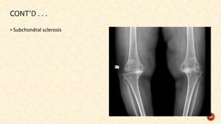  Subchondral sclerosis
66
 