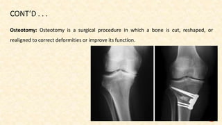 Osteotomy: Osteotomy is a surgical procedure in which a bone is cut, reshaped, or
realigned to correct deformities or improve its function.
74
 