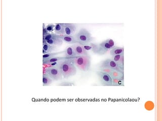 Quando podem ser observadas no Papanicolaou?
 