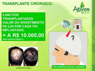 TRANSPLANTE CIRÚRGICO:  PÓS CIRÚRGIA MUITOS CUIDADOS 5.000 FIOS TRANSPLANTADOS VALOR DO INVESTIMENTO R$ 2,00 POR CADA FIO IMPLANTADO. = A R$ 10.000,00 (NÃO GARANTIDOS!!!!) ? ATIVOS DA FLORA 