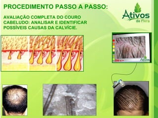 PROCEDIMENTO PASSO A PASSO: AVALIAÇÃO COMPLETA DO COURO CABELUDO: ANALISAR E IDENTIFICAR POSSÍVEIS CAUSAS DA CALVÍCIE. 250 x + 