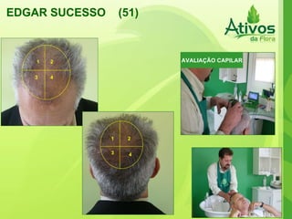 EDGAR SUCESSO  (51) 1 2 3 4 1 2 3 4 AVALIAÇÃO CAPILAR 