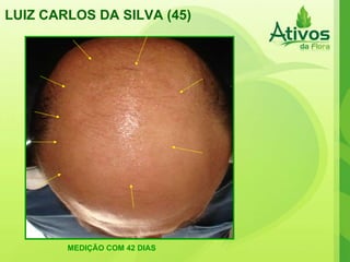 LUIZ CARLOS DA SILVA (45) MEDIÇÃO COM 42 DIAS 