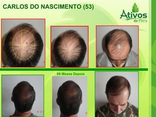 CARLOS DO NASCIMENTO (53) 1 2 3 4 06 Meses Depois 